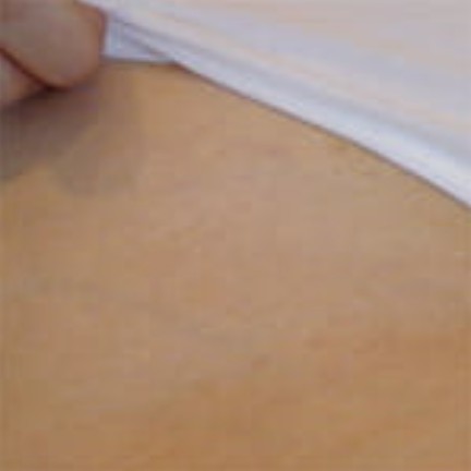 Extended Bikini after laser hair removal
