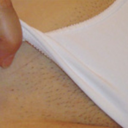 Extended Bikini before laser hair removal