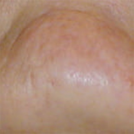Chin after laser hair removal