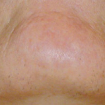 Chin before laser hair removal