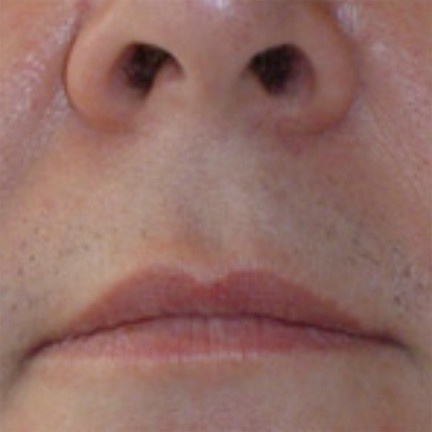 Upper Lip before laser hair removal