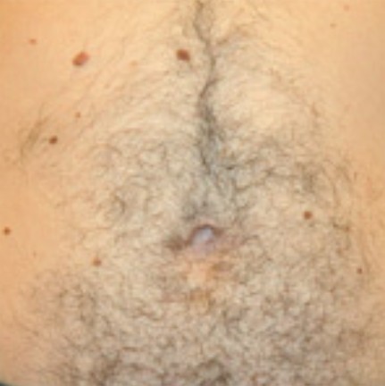 Stomach before laser hair removal