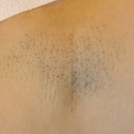 Underarm before laser hair removal